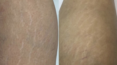 Microneedling Photo